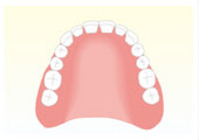 プラスチックで出来た総入れ歯（保険治療）
