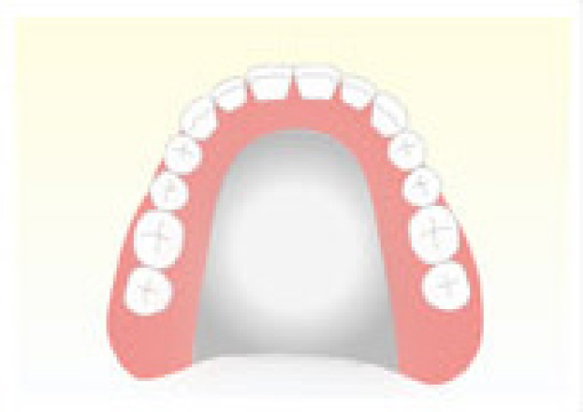 金属で出来た入れ歯（自費治療）