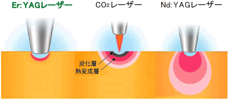 レーザーイメージ