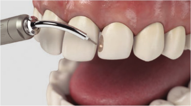 歯石除去・歯周病治療